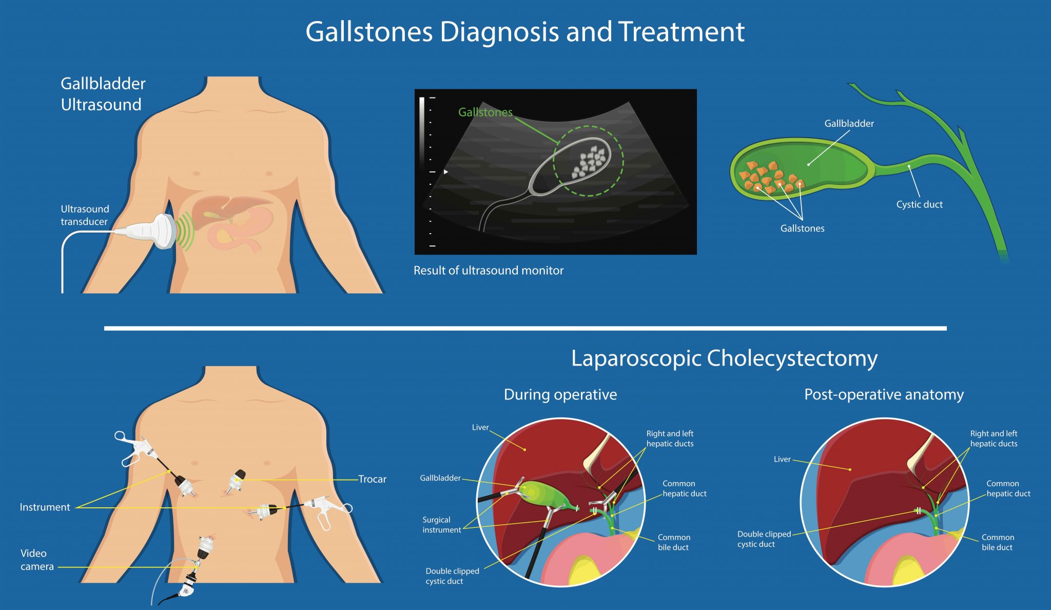 What are the Signs And Symptoms Of Gallstones? Louise Mcgarrigle